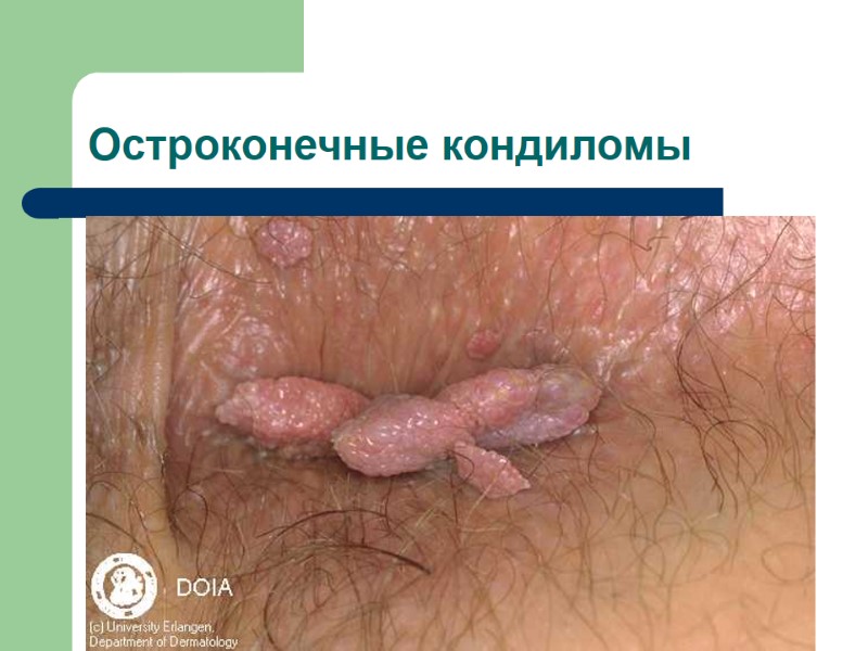 Остроконечные кондиломы